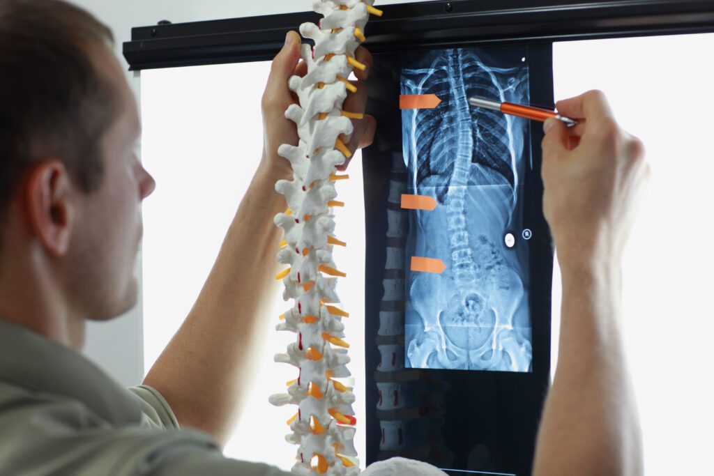 chiropractor analyzing xray of a patient with scoliosis